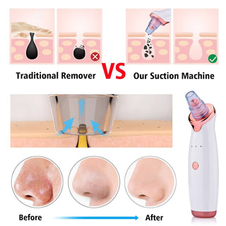 Electric Blackhead Suction Device – Acne Remover & Facial Cleansing Tool